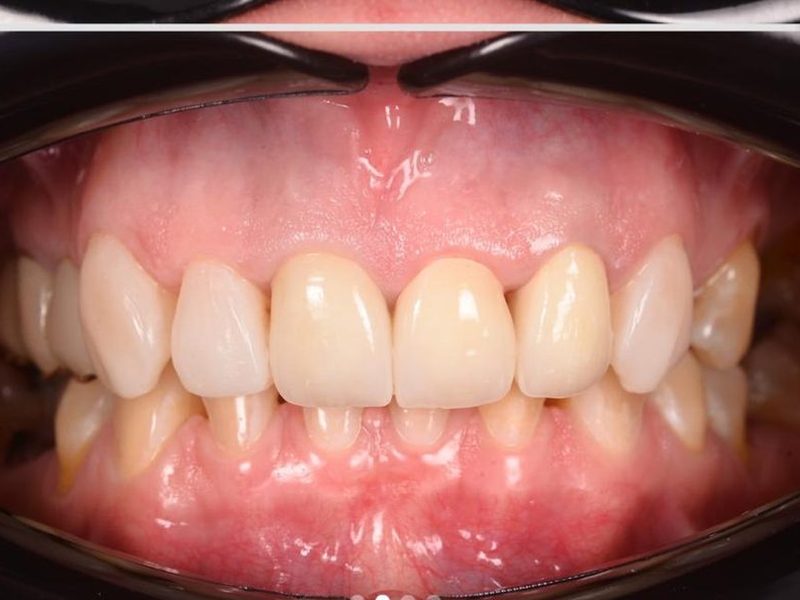 After full smile makeover at Omega Dental Pulpally