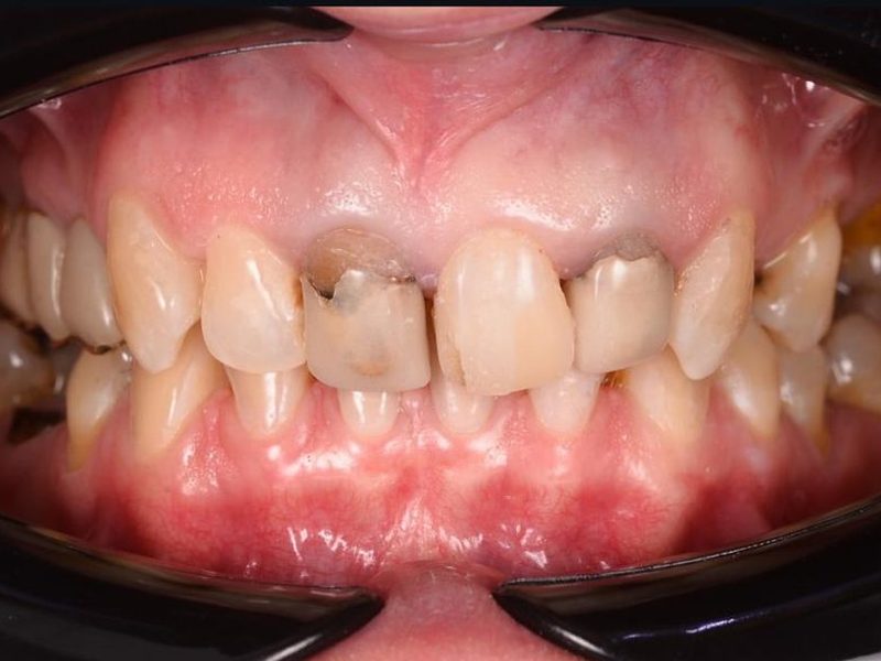 Before full smile makeover at Omega Dental Pulpally