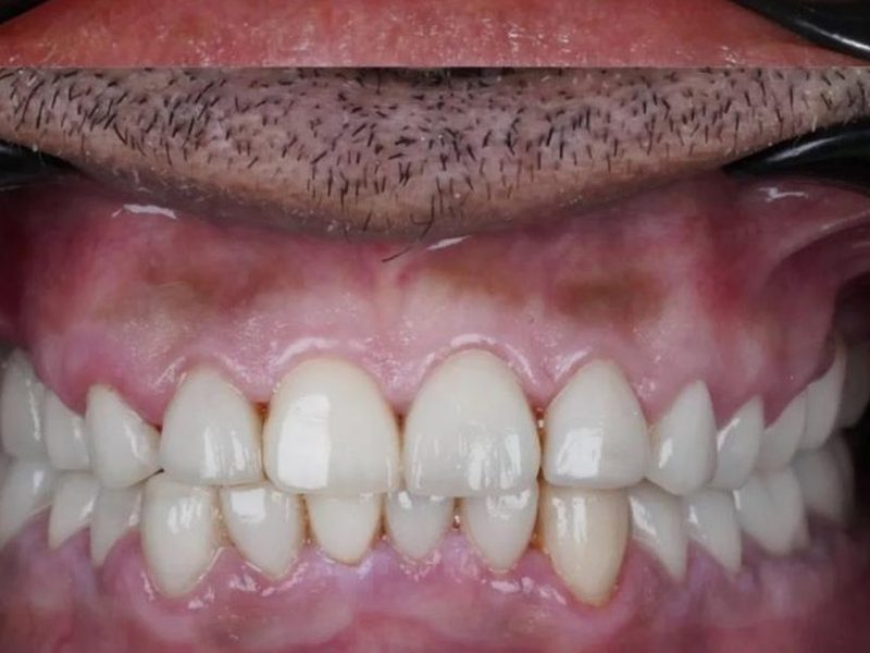 After front teeth crowns at Omega Dental Pulpally