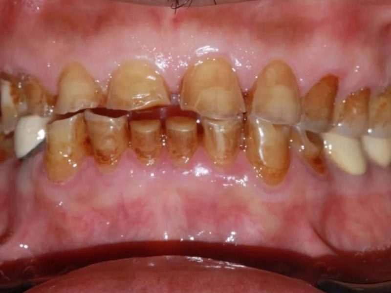 Before front teeth crowns at Omega Dental Pulpally