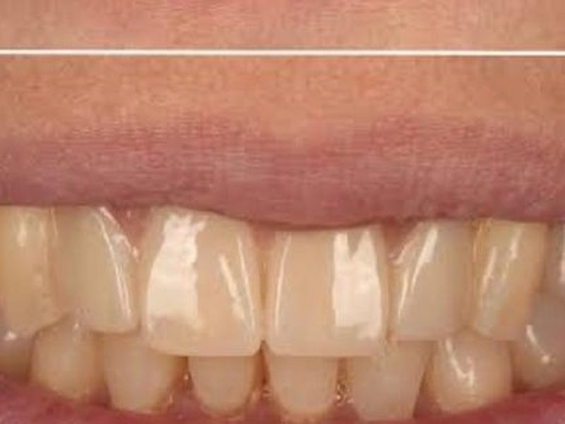 After dental bridge for missing teeth at Omega Dental Pulpally