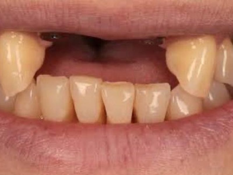 Before dental bridge for missing teeth at Omega Dental Pulpally