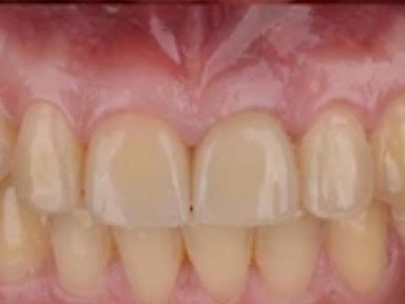 After broken tooth restoration at Omega Dental Pulpally