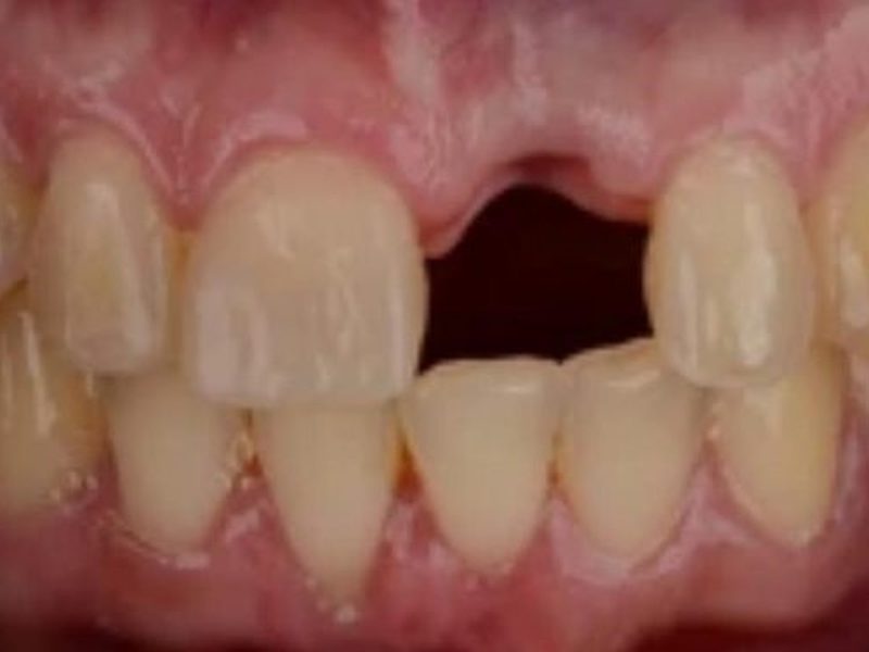 Before broken tooth restoration at Omega Dental Pulpally